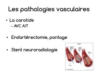 Les pathologies vasculaires
• La carotide
– AVC AIT
• Endartérectomie, pontage
• Stent neuroradiologie
 