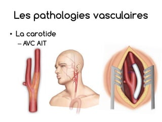 Les pathologies vasculaires
• La carotide
– AVC AIT
 