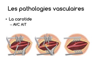 Les pathologies vasculaires
• La carotide
– AVC AIT
 