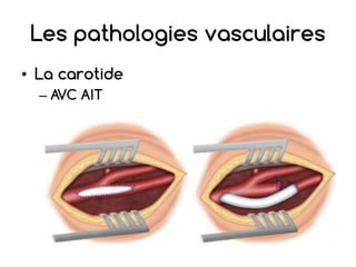 Les pathologies vasculaires
• La carotide
– AVC AIT
 