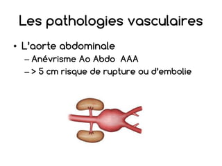 Les pathologies vasculaires
• L’aorte abdominale
– Anévrisme Ao Abdo AAA
– > 5 cm risque de rupture ou d’embolie
 