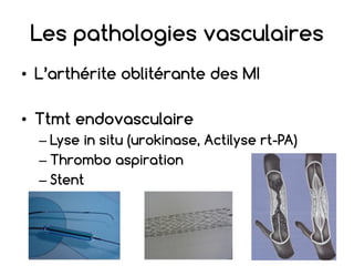 Les pathologies vasculaires
• L’arthérite oblitérante des MI
• Ttmt endovasculaire
– Lyse in situ (urokinase, Actilyse rt-PA)
– Thrombo aspiration
– Stent
 