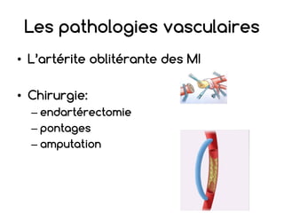 Les pathologies vasculaires
• L’artérite oblitérante des MI
• Chirurgie:
– endartérectomie
– pontages
– amputation
 