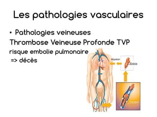 Les pathologies vasculaires
• Pathologies veineuses
Thrombose Veineuse Profonde TVP
risque embolie pulmonaire
=> décès
 
