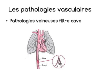 Les pathologies vasculaires
• Pathologies veineuses filtre cave
 