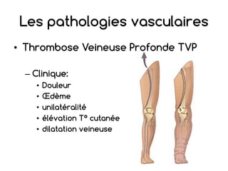 Les pathologies vasculaires
• Thrombose Veineuse Profonde TVP
– Clinique:
• Douleur
• Œdème
• unilatéralité
• élévation T° cutanée
• dilatation veineuse
 