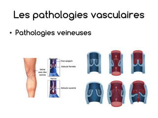 Les pathologies vasculaires
• Pathologies veineuses
 