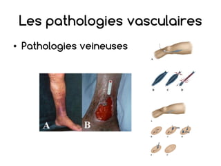 Les pathologies vasculaires
• Pathologies veineuses
 