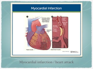 Myocardial infarction / heart attack
 