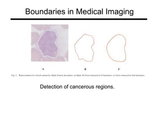 Boundaries in Medical Imaging
Detection of cancerous regions.
 