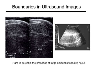 Boundaries in Ultrasound Images
Hard to detect in the presence of large amount of speckle noise
 