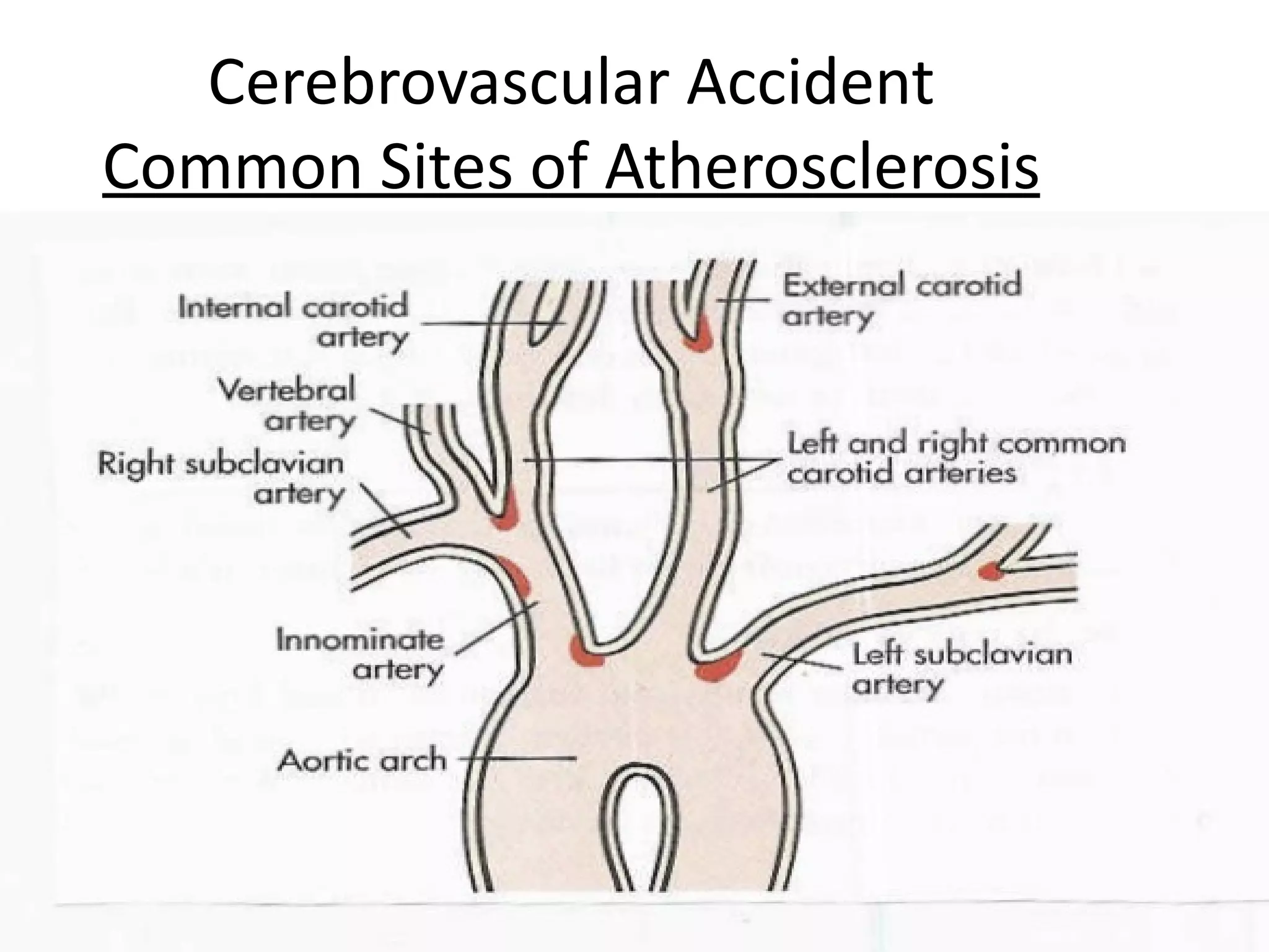 Cerebrovascular Accident
Common Sites of Atherosclerosis




                                  16
 