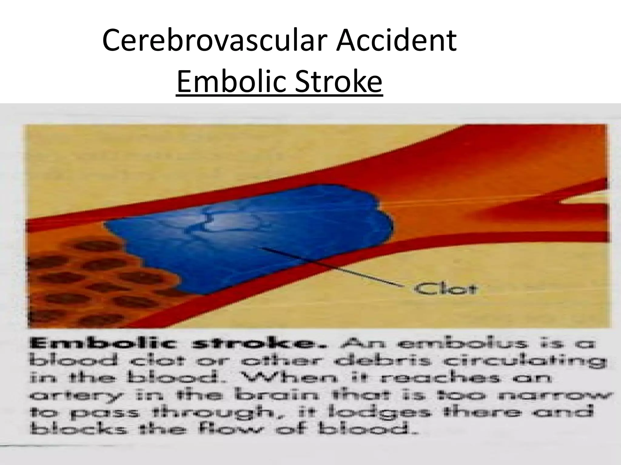 Cerebrovascular Accident
     Embolic Stroke




                           19
 