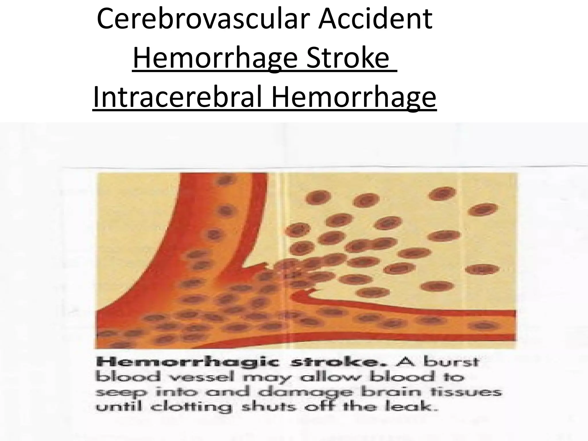 Cerebrovascular Accident
   Hemorrhage Stroke
Intracerebral Hemorrhage




                           22
 