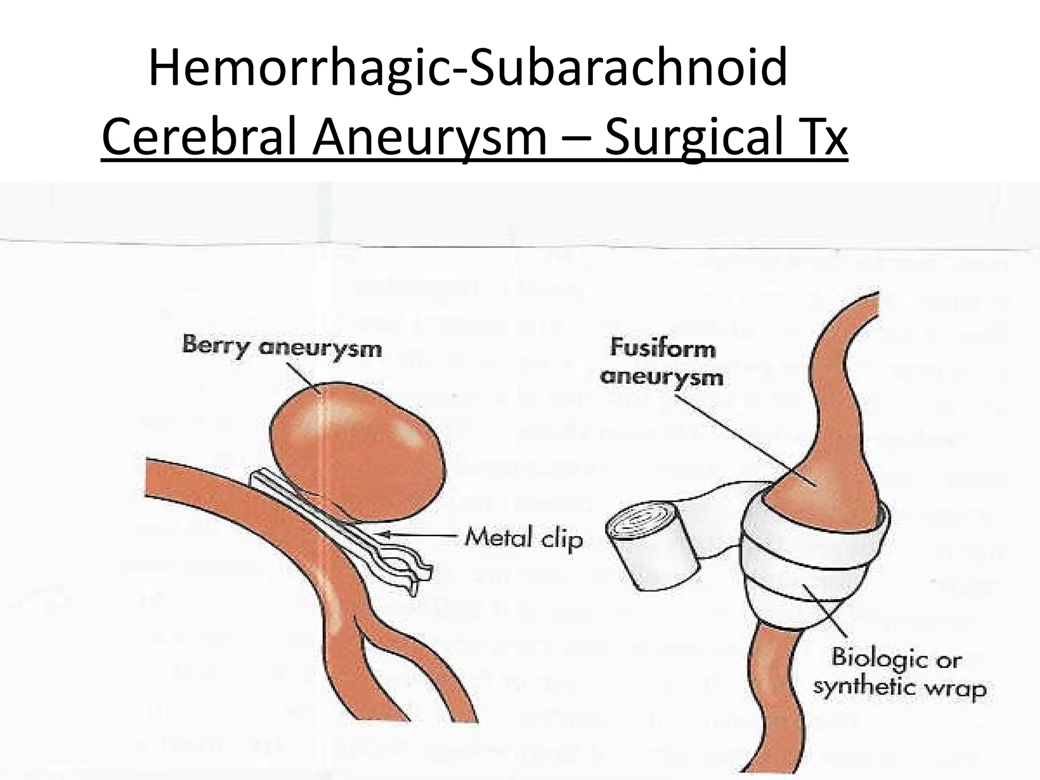 Hemorrhagic-Subarachnoid
Cerebral Aneurysm – Surgical Tx




                                  29
 