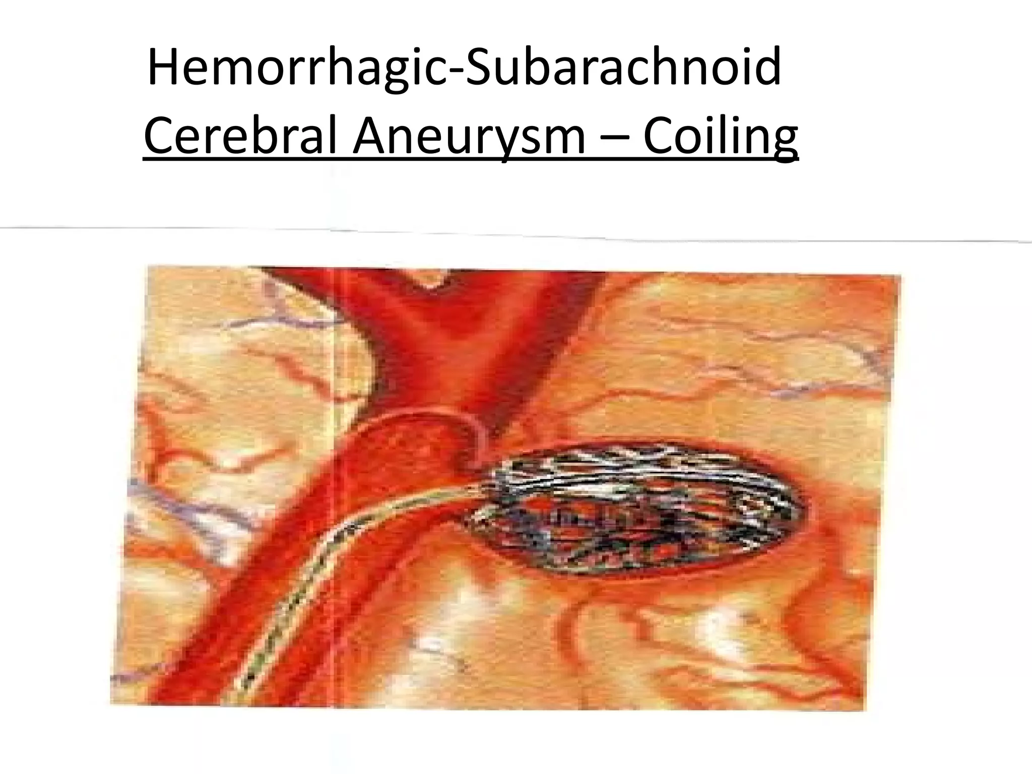 Hemorrhagic-Subarachnoid
Cerebral Aneurysm – Coiling




                              30
 