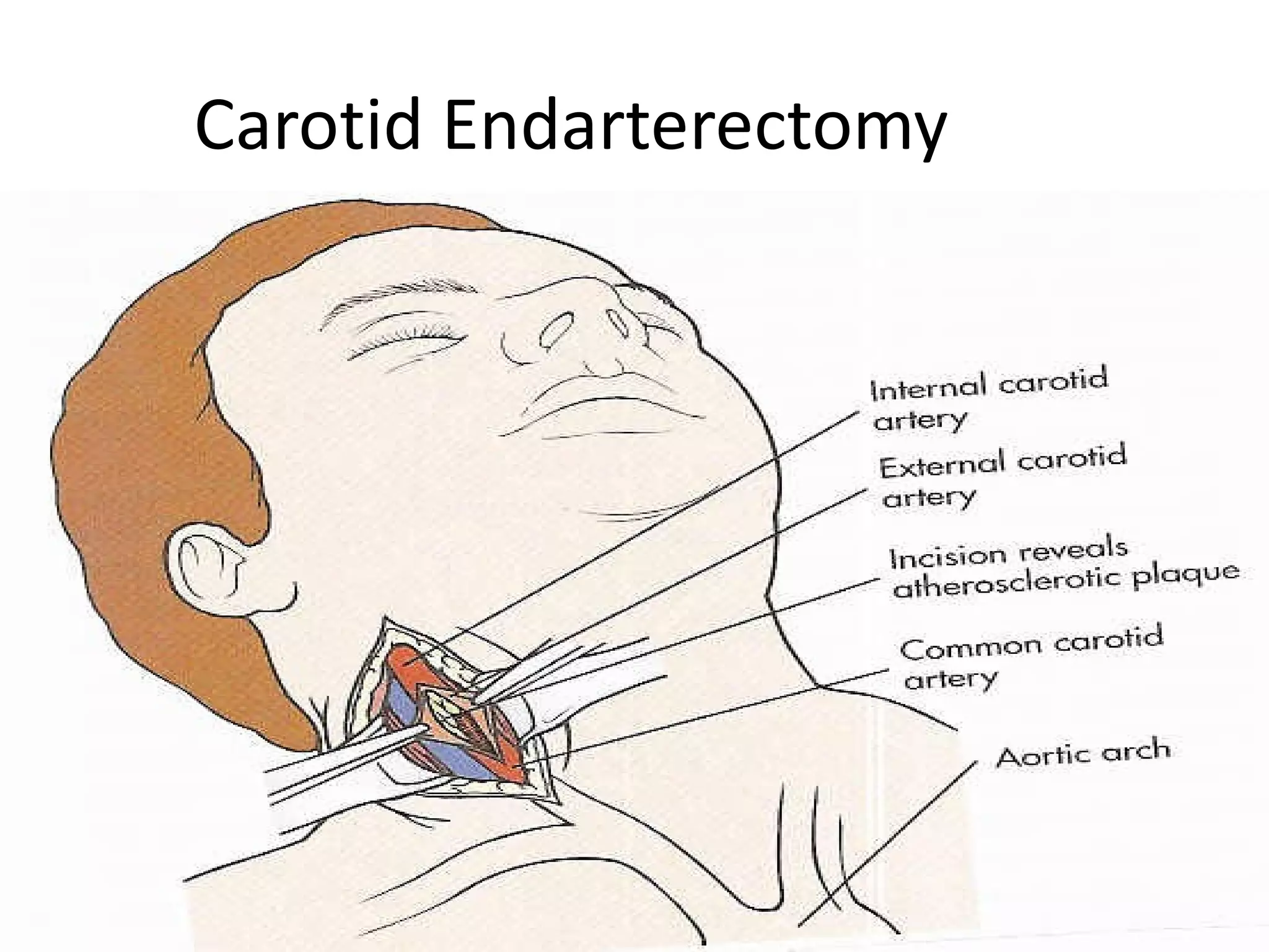 Carotid Endarterectomy




                         51
 