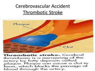 Cerebrovascular Accident
   Thrombotic Stroke




                           14
 