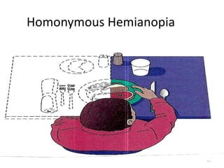 Homonymous Hemianopia




                        43
 