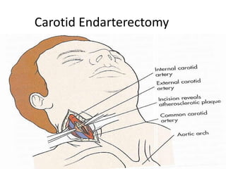 Carotid Endarterectomy




                         51
 