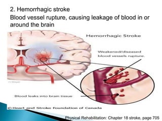 2. Hemorrhagic stroke
Blood vessel rupture, causing leakage of blood in or
around the brain
Physical Rehabilitation: Chapter 18 stroke, page 705
 