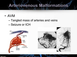 • AVM
– Tangled mass of arteries and veins
– Seizure or ICH
 