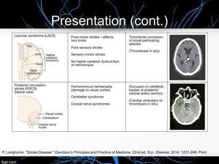 Presentation (cont.)
P, Langhorne. "Stroke Disease." Davidson’s Principles and Practice of Medicine. 22nd ed. N.p.: Elsevier, 2014. 1231-248. Print.
 