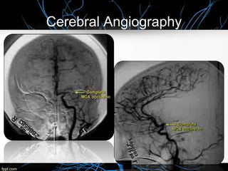 Cerebral Angiography
 
