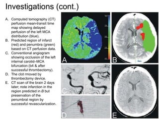 Investigations (cont.)
A. Computed tomography (CT)
perfusion mean-transit time
map showing delayed
perfusion of the left MCA
distribution (blue).
B. Predicted region of infarct
(red) and penumbra (green)
based on CT perfusion data.
C. Conventional angiogram
showing occlusion of the left
internal carotid–MCA
bifurcation (b4 & after
successful thrombectomy).
D. The clot rmoved by
thrombectomy device.
E. CT scan of the brain 2 days
later; note infarction in the
region predicted in B but
preservation of the
penumbral region by
successful revascularization.
 
