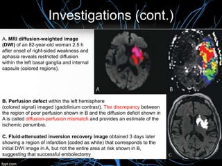 Investigations (cont.)
A. MRI diffusion-weighted image
(DWI) of an 82-year-old woman 2.5 h
after onset of right-sided weakness and
aphasia reveals restricted diffusion
within the left basal ganglia and internal
capsule (colored regions).
B. Perfusion defect within the left hemisphere
(colored signal) imaged (gadolinium contrast). The discrepancy between
the region of poor perfusion shown in B and the diffusion deficit shown in
A is called diffusion-perfusion mismatch and provides an estimate of the
ischemic penumbra.
C. Fluid-attenuated inversion recovery image obtained 3 days later
showing a region of infarction (coded as white) that corresponds to the
initial DWI image in A, but not the entire area at risk shown in B,
suggesting that successful embolectomy
 