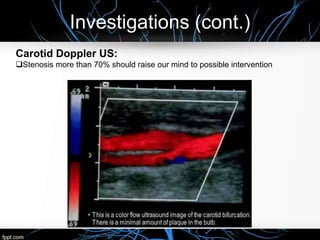 Investigations (cont.)
Carotid Doppler US:
Stenosis more than 70% should raise our mind to possible intervention
 