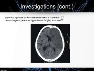 Investigations (cont.)
Infarction appears as hypodense (more dark) area on CT
Hemorrhage appeare as hyperdesne (bright) area on CT
 