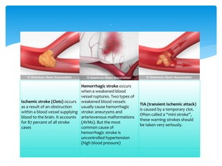 Ischemic stroke (Clots) occurs
as a result of an obstruction
within a blood vessel supplying
blood to the brain. It accounts
for 87 percent of all stroke
cases
Hemorrhagic stroke occurs
when a weakened blood
vessel ruptures. Two types of
weakened blood vessels
usually cause hemorrhagic
stroke: aneurysms and
arteriovenous malformations
(AVMs). But the most
common cause of
hemorrhagic stroke is
uncontrolled hypertension
(high blood pressure)
TIA (transient ischemic attack)
is caused by a temporary clot.
Often called a “mini stroke”,
these warning strokes should
be taken very seriously.
.
 
