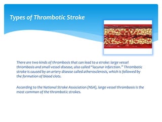 There are two kinds of thrombosis that can lead to a stroke: large vessel
thrombosis and small vessel disease, also called “lacunar infarction.” Thrombotic
stroke is caused by an artery disease called atherosclerosis, which is followed by
the formation of blood clots.
According to the National Stroke Association (NSA), large vessel thrombosis is the
most common of the thrombotic strokes.
Types of Thrombotic Stroke
 