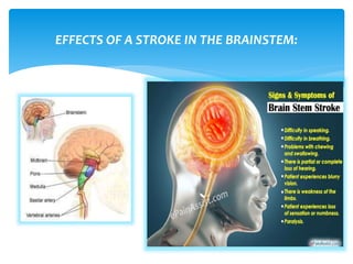 EFFECTS OF A STROKE IN THE BRAINSTEM:
 