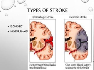 TYPES OF STROKE
• ISCHEMIC
• HEMORRHAGIC
 