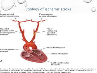 Etiology of ischemic stroke
 