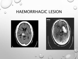 HAEMORRHAGIC LESION
 