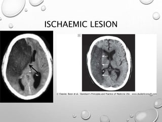 ISCHAEMIC LESION
 