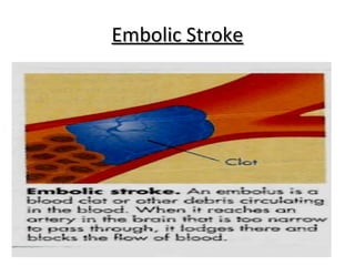 Cva (cerebro vascular accident) | PPT