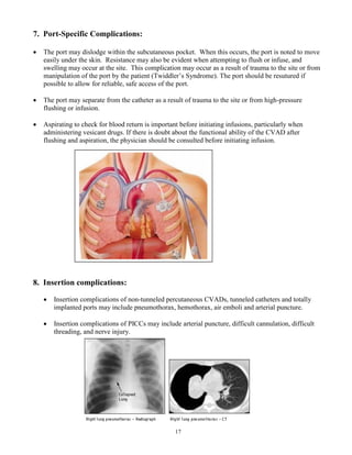 17
7. Port-Specific Complications:
 The port may dislodge within the subcutaneous pocket. When this occurs, the port is noted to move
easily under the skin. Resistance may also be evident when attempting to flush or infuse, and
swelling may occur at the site. This complication may occur as a result of trauma to the site or from
manipulation of the port by the patient (Twiddler’s Syndrome). The port should be resutured if
possible to allow for reliable, safe access of the port.
 The port may separate from the catheter as a result of trauma to the site or from high-pressure
flushing or infusion.
 Aspirating to check for blood return is important before initiating infusions, particularly when
administering vesicant drugs. If there is doubt about the functional ability of the CVAD after
flushing and aspiration, the physician should be consulted before initiating infusion.
8. Insertion complications:
 Insertion complications of non-tunneled percutaneous CVADs, tunneled catheters and totally
implanted ports may include pneumothorax, hemothorax, air emboli and arterial puncture.
 Insertion complications of PICCs may include arterial puncture, difficult cannulation, difficult
threading, and nerve injury.
 