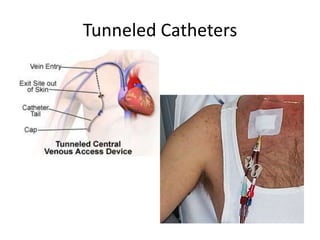 Tunneled Catheters
 