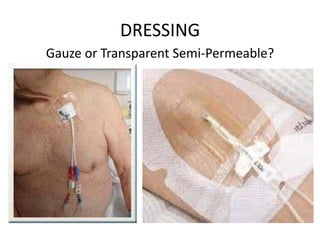 DRESSING
Gauze or Transparent Semi-Permeable?
 