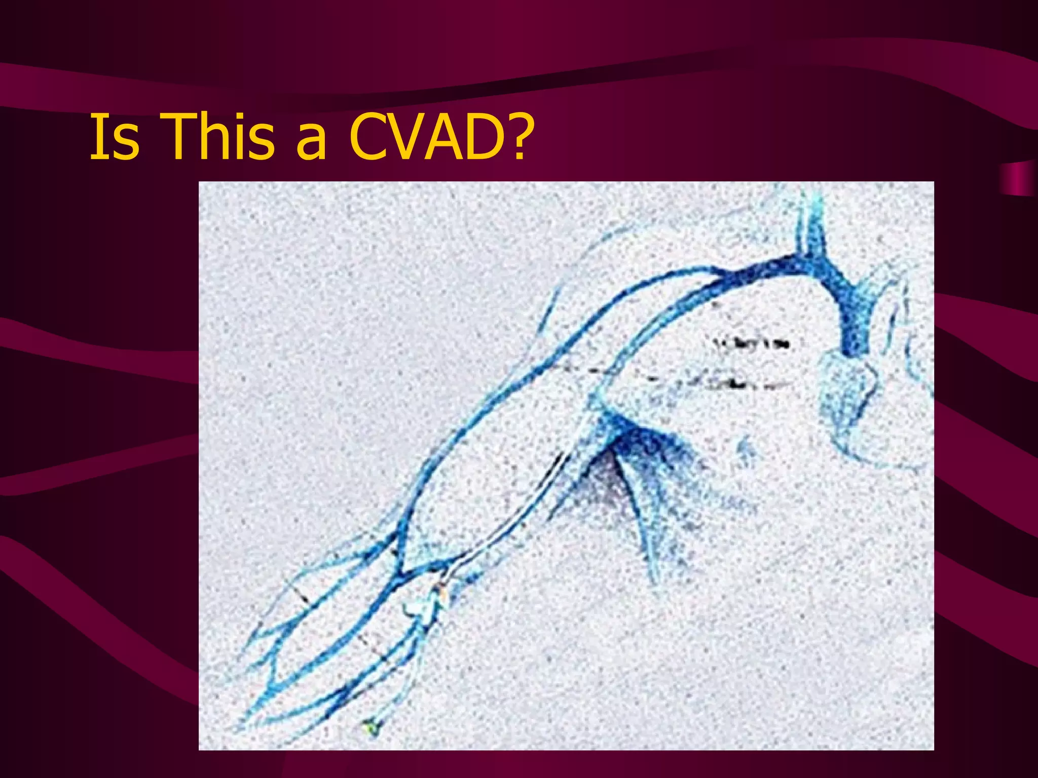 Assessing for Complications Do bag-to-tip check Examination of catheter tract is more involved for central line Start with port site or skin entry site Visually inspect along tunnel (if any) to venous entry site Mentally think about where tip is and the  complications that can arise 