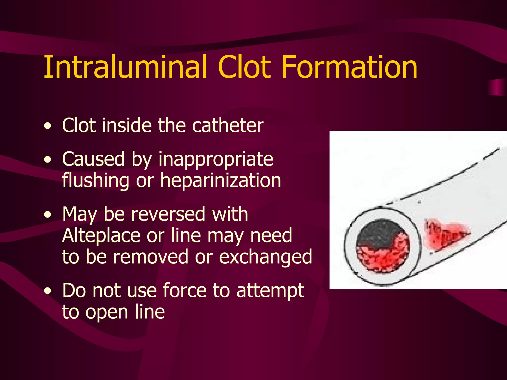 Fibrin Sheath Can extend along entire catheter tract and cause fluid to leak from insertion site 