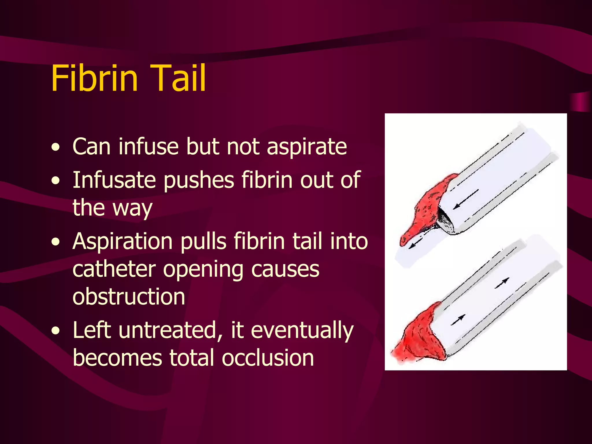 Fibrin-Tail For a period of time blood could not be aspirated from one port, but it infused well. Eventually the lumen occluded.  Alteplace could not open it. This patient now has  chemotherapy running into a peripheral line. Occluded Photo: C. Lewis 