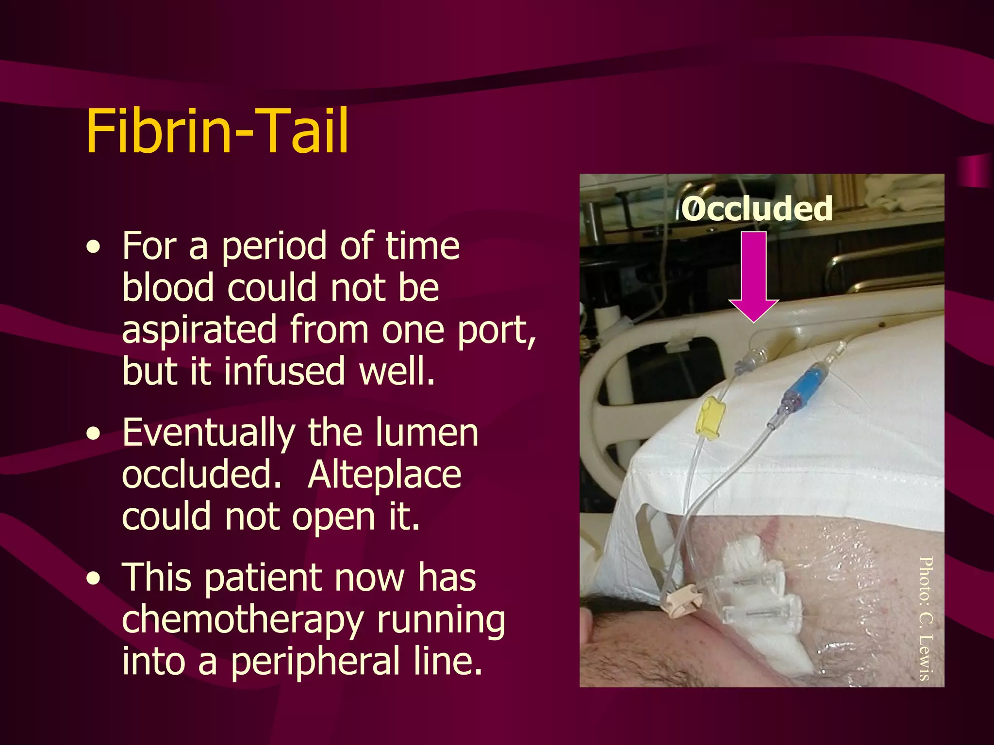 Fibrin Occlusion May be Amenable to Thrombolytic Therapy Intraluminal clot Fibrin sheath Fibrin tail Mural thrombus 