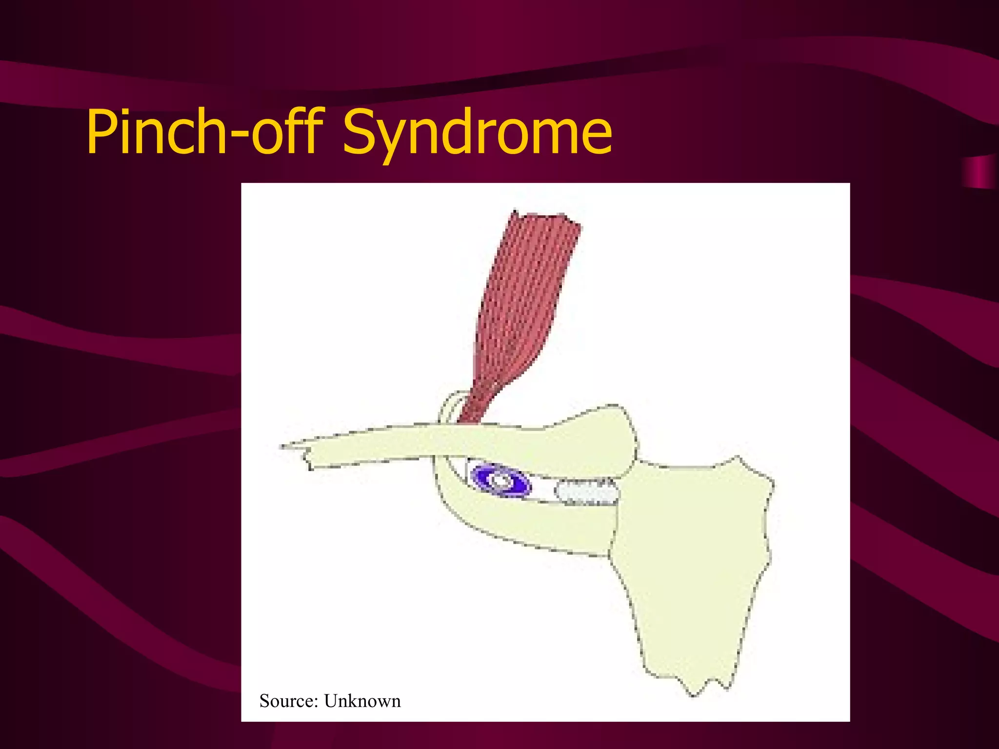 Tunneled CVADs Tunneling the catheter under the skin increases the distance from the port access to the venous access Skin provides a germ barrier Catheter has Dacron cuff that should never be visible Assess entire length of tunnel track for signs of pain, reddness, induration 