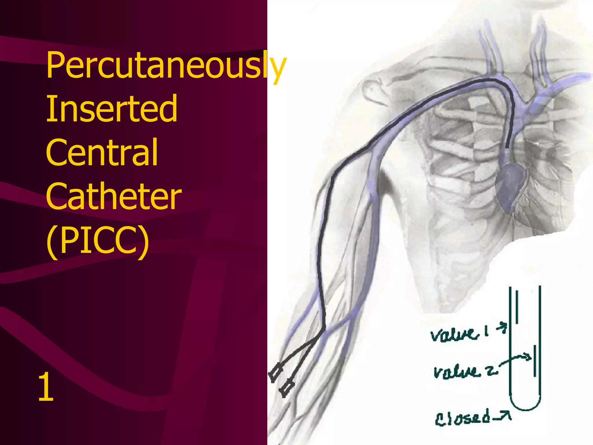 Implanted Vascular Access Device (Port-A-Cath) 2 