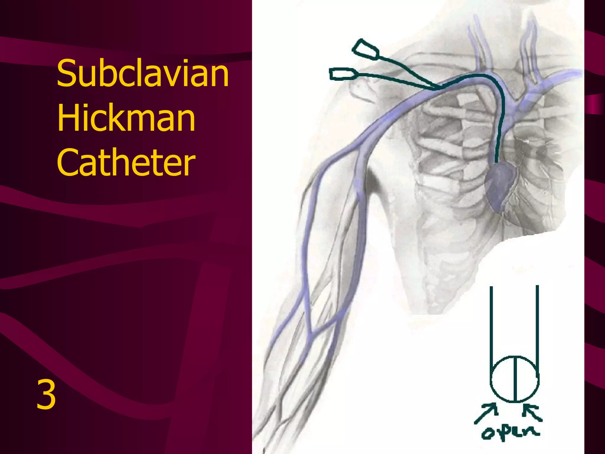 Tunneled Dialysis  Catheter 4 
